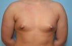 Tubular Breast Deformity