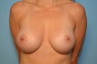 Breast Augmentation