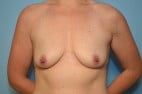 Breast Augmentation