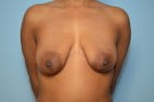 Breast Augmentatio with Standard Lift