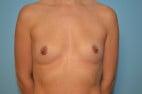 Breast Augmentation