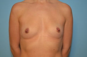 Breast Augmentation