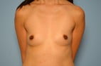 Breast Augmentation