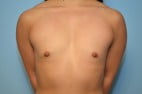 Breast Augmentation