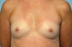 Breast Augmentation