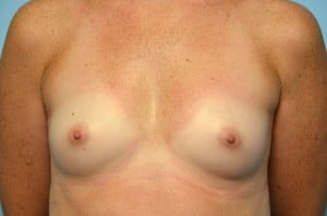 Breast Augmentation