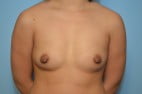 Breast Augmentation