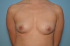 Breast Augmentation