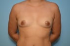 Breast Augmentation