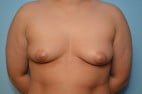 Breast Augmentation