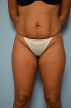 Umbilical float tummy tuck, liposuction abdomen, flanks