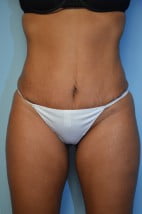 Umbilical float tummy tuck, liposuction abdomen, flanks