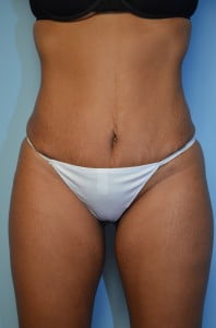Umbilical float tummy tuck, liposuction abdomen, flanks