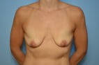 Breast Augmentation, Breast Lift