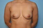 Breast Augmentation