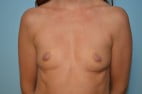 Breast Augmentation