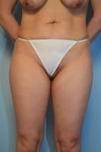 Umbilical Float Tummy Tuck