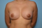 Breast Augmentation