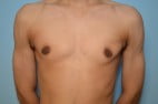 Gynecomastia