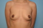 Breast Augmentation