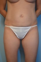 Umbilical Float Tummy Tuck