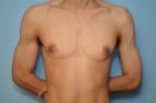 Gynecomastia