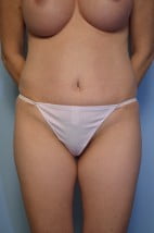Umbilical Float Tummy Tuck