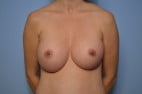 Breast Augmentation