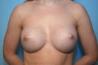 Breast Augmentation