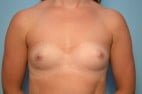 Breast Augmentation