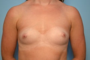 Breast Augmentation