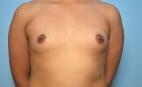 Breast Augmentation