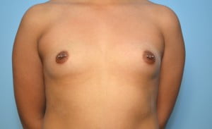 Breast Augmentation
