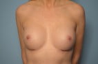 Breast Augmentation