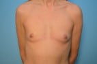 Breast Augmentation