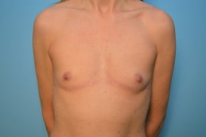 Breast Augmentation