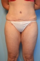 TT + liposuction