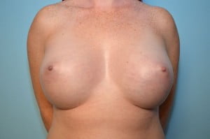 Breast Augmentation