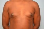 Gynecomastia