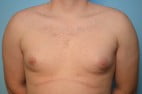 Gynecomastia