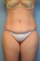 TT + liposuction