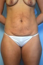 Abdominoplasty