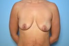 Breast lift with augmentation
