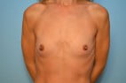 Breast Augmentation