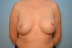 Breast Implant Exchange