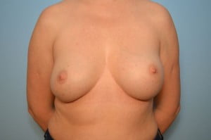 Breast Implant Exchange