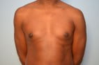 Gynecomastia