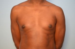 Gynecomastia