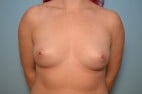 Breast Augmentation