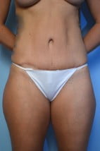 Abdominoplasty